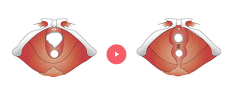 Pelvic Muscle Reinforcement