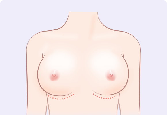 乳房褶皱位置切开法