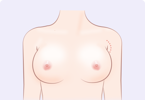 Sayatan Ketiak (Transaxillary)