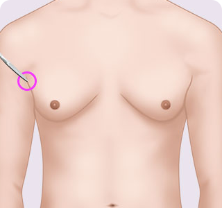 Metode Operasi Reduksi Payudara Pria 01