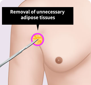Unnecessary adipose tissues are removed