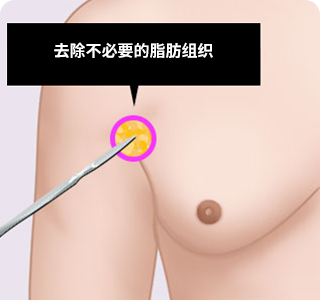 男性女乳房的手术方法