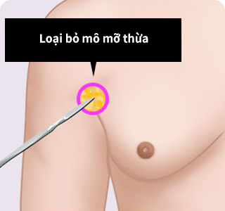 Phương pháp phẫu thuật thu nhỏ ngực cho nam giới 02