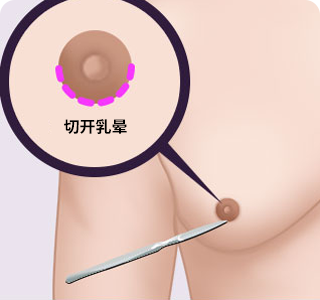 男性女乳房的手术方法