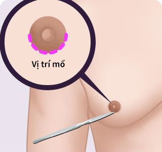 Phương pháp phẫu thuật thu nhỏ ngực cho nam giới 03