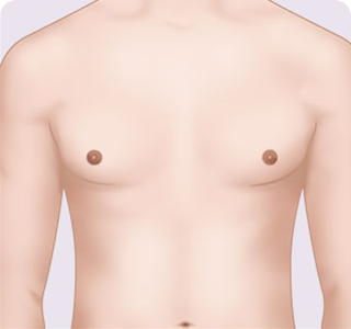 男性の乳房縮小の 手術方法04