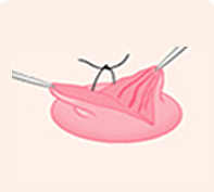 Suture in stages