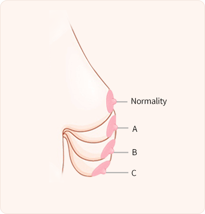 Levels of Breast Sagging