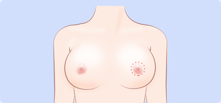 Areola Incision