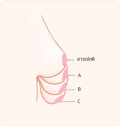 ระดับการหย่อนคล้อยของเต้านม