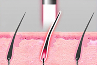 Kelebihan Laser Penghilang Bulu