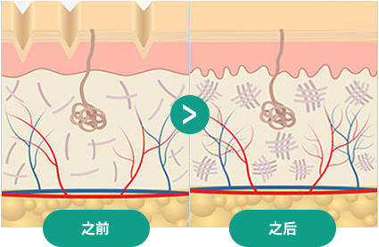 线提升术的原理