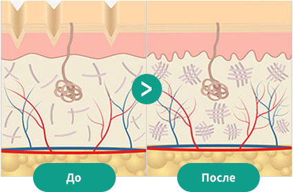 Принцип нитевой подятжки