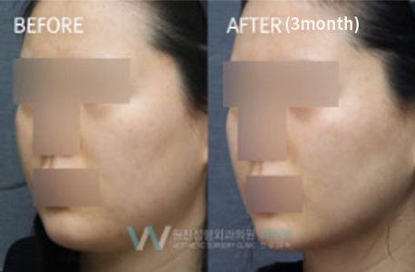 Face Contour Injection