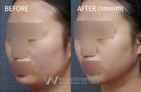 Face Contour Injection