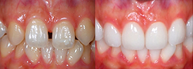 歯と歯の間隔が広い場合
