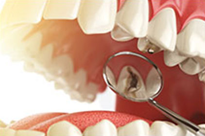 虫歯治療