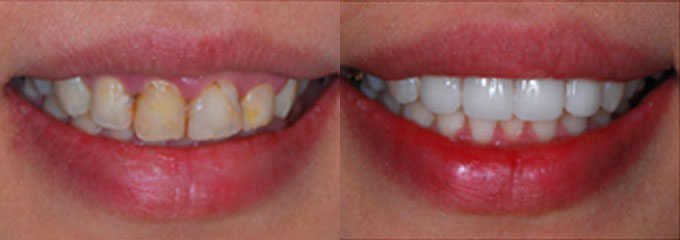 Teeth discoloration