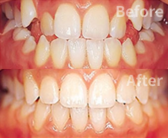 Misaligned Teeth