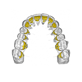 Lingual Orthodontics (Incognito)