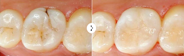 ประเภทของการรักษาฟันผุ ยางเรซิน