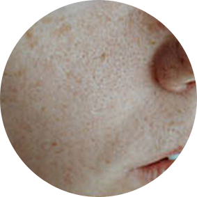 Melasma