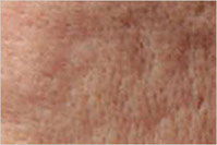Acne Scar