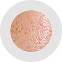 Melasma Pores