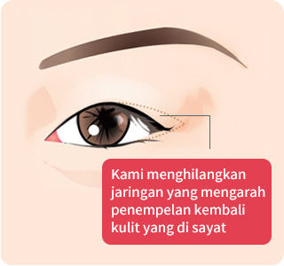 Kami menghilangkan jaringan yang membuat kulit yang di sayat menempel kembali