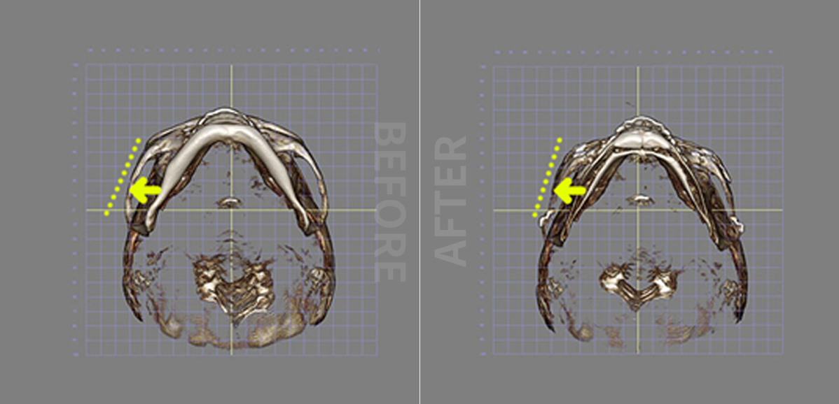 Cheekbone surgery