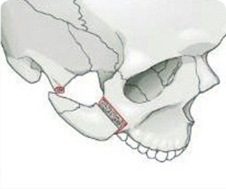 Cắt xương hàm trên và hàm dưới