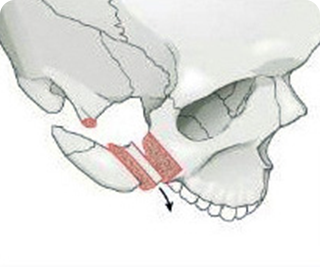 切骨した骨を適切な位置に移動させます