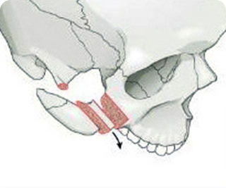 Surgical Methods of Cheekbone Reduction Step 02