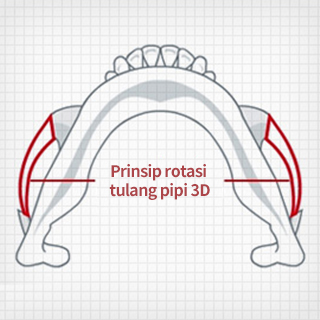 Metode Operasi untuk Reduksi Tulang Pipi