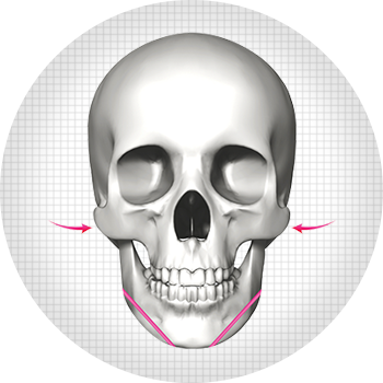 U-line facial contouring