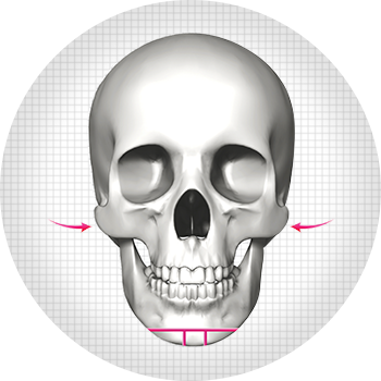 Chỉnh hình xương hàm mặt dáng V-line