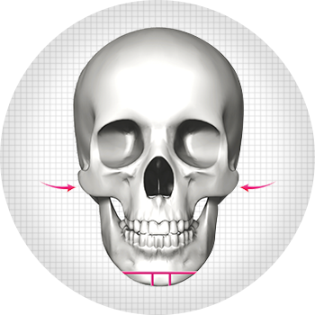 V-line facial contouring