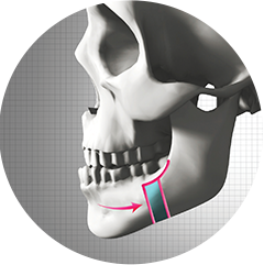 U-line facial contouring