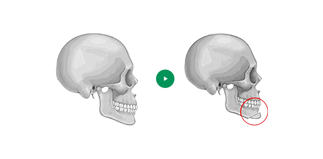 Chin Advancement