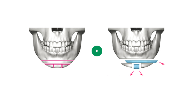 Dagu Panjang T-Osteotomy