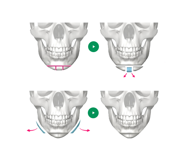 T-Osteotomy