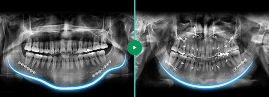 WONJIN’s V-line Surgery Before & After