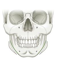 Mandibular Resection