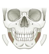 Cortical Resection