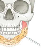 Buccal Fat Removal