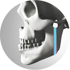 IVRO (Intraoral Vertical Ramus Osteotomy)