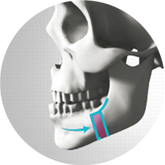 SSRO (Sagittal Split Ramus Osteotomy)