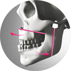 両顎手術方法