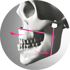 Two Jaw Surgery