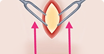 Incision and Desquamation